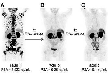 Actinium-225 treatment, before and after