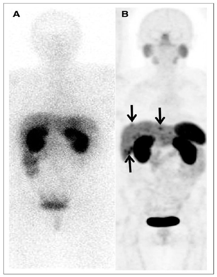 Comparing Indium-111 to Gallium-68 as radioactive tracers in medical scans